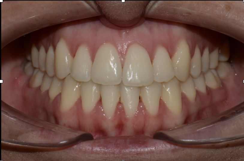 Dopo del trattamento odontoiatrico